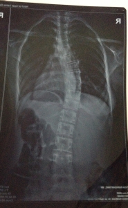 x-ray-spine-kaka.jpg